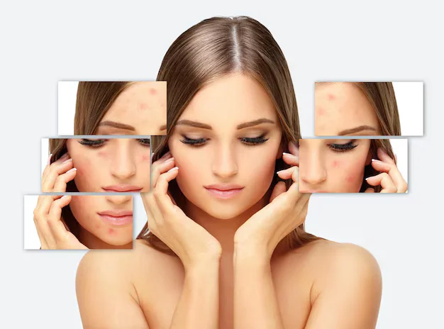 بشرة صافية وخالية من الحبوب بعد العلاج الفعّال مع دكتورة نجلاء الزغبي في بنها