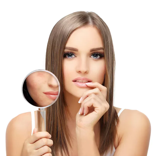 تقنية حديثة لعلاج الكلف بسرعة مع نتائج فعالة