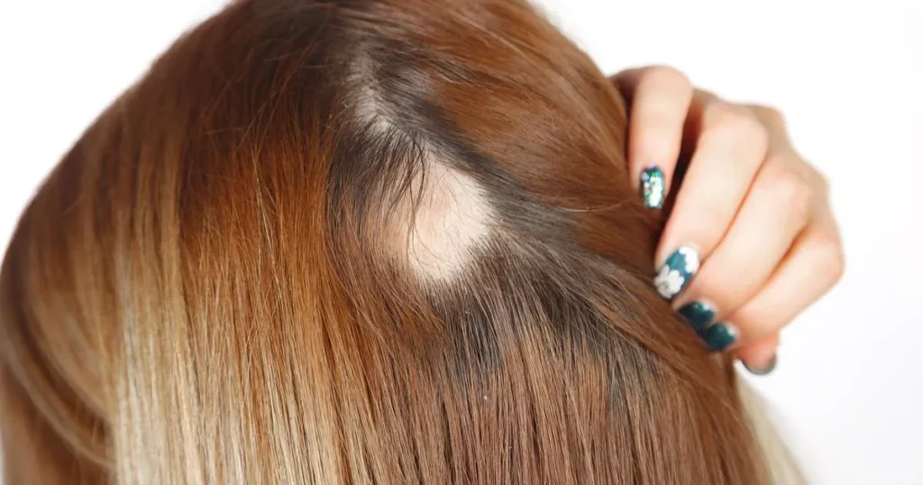 استشارة طبية لعلاج الثعلبة في مركز لاروز بنها