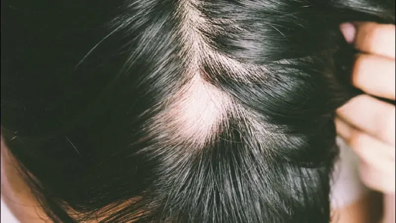 احدث طرق علاج الثعلبة نهائيا مع دكتورة نجلاء الزغبي في بنها