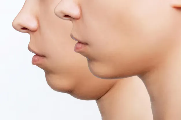 نتائج قبل وبعد علاج الذقن المزدوج بطرق متطورة في مركز لاروز بنها