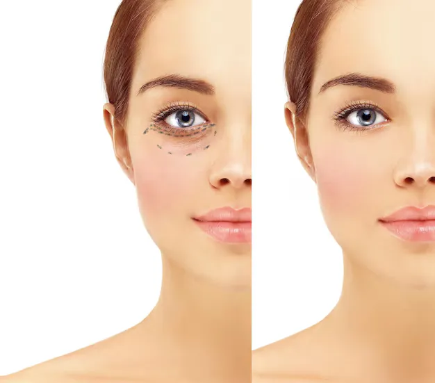 نتائج مذهلة بعد تطبيق طريقة ازالة الهالات السوداء تحت العين