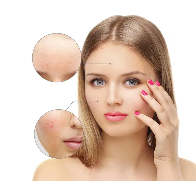 نتائج علاج ندبات الوجه نهائيا مع د. نجلاء الزغبي