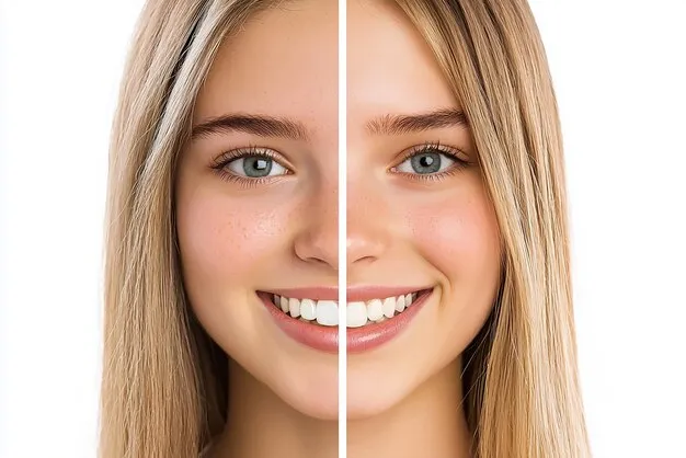 نتائج فيلر خطوط الابتسامة قبل وبعد مع د. نجلاء الزغبي