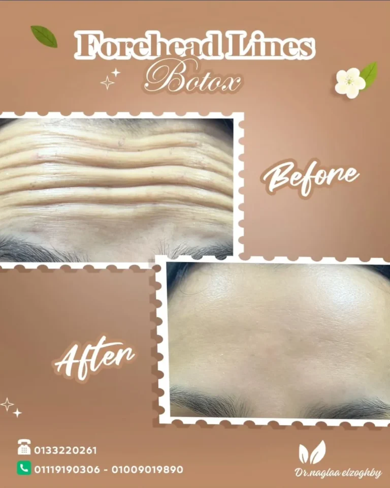 نتائج قبل وبعد التجميل في افضل عيادة تجميل في مصر