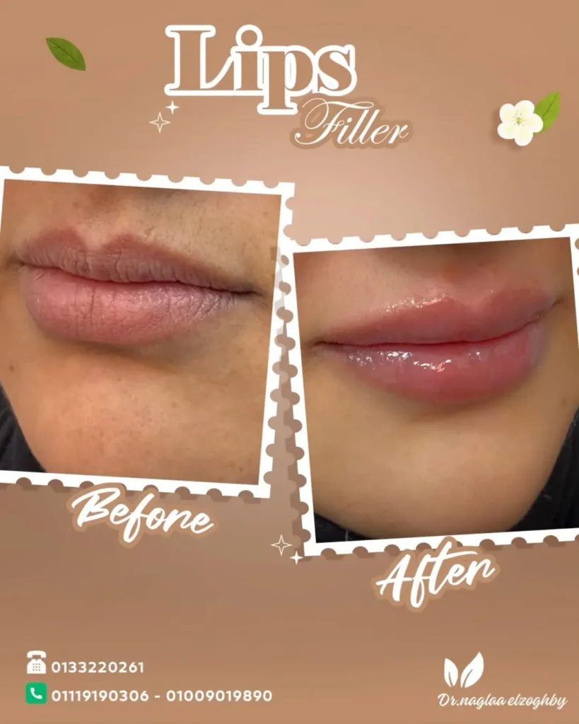 علاج الفيلر والبوتوكس في افضل عيادة تجميل في مصر