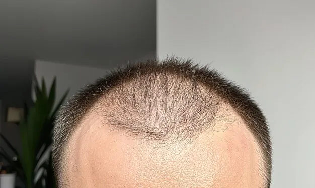 تجربتي مع فراغات الشعر قبل العلاج ظهور فراغات وتساقط واضح للشعر