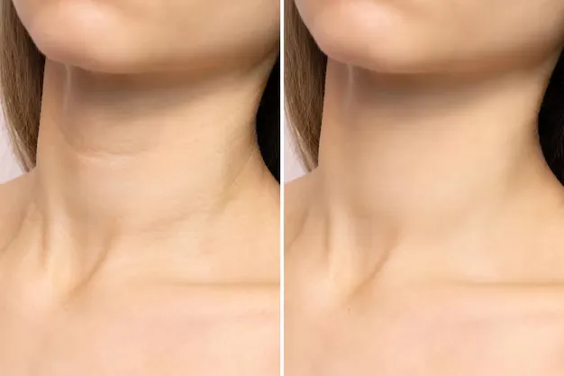 بوتكس الرقبة قبل وبعد لإخفاء تجاعيد الرقبة الدقيقة