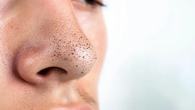 علاج الرؤوس السوداء في الانف نهائيا​ قبل العلاج في مركز لاروز تحت إشراف دكتور نجلاء