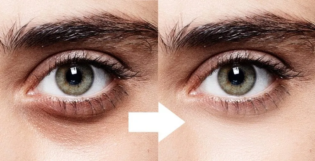 كيفية علاج تجويف تحت العين